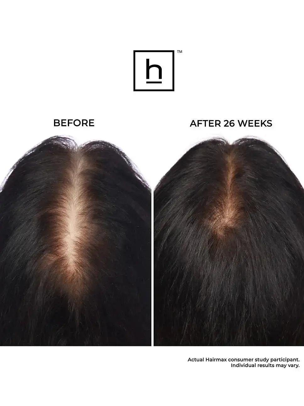 LASERBAND 82 ComfortFlex - Image 16