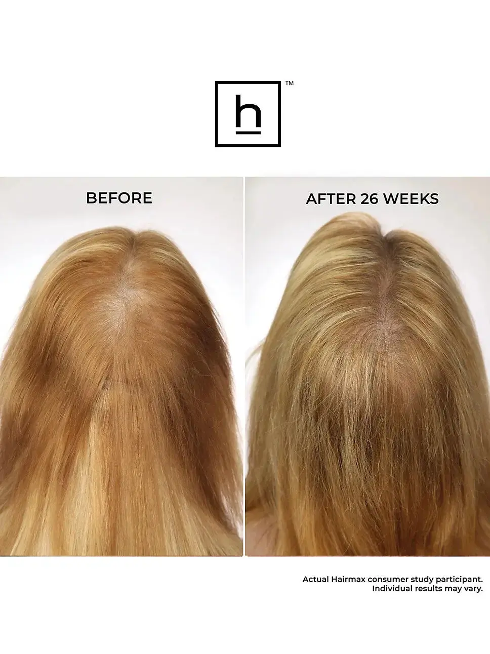 LASERBAND 82 ComfortFlex - Image 15